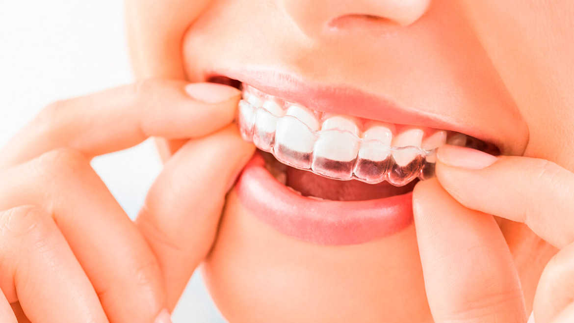 ¿Por qué optar por Invisalign, la ortodoncia invisible?